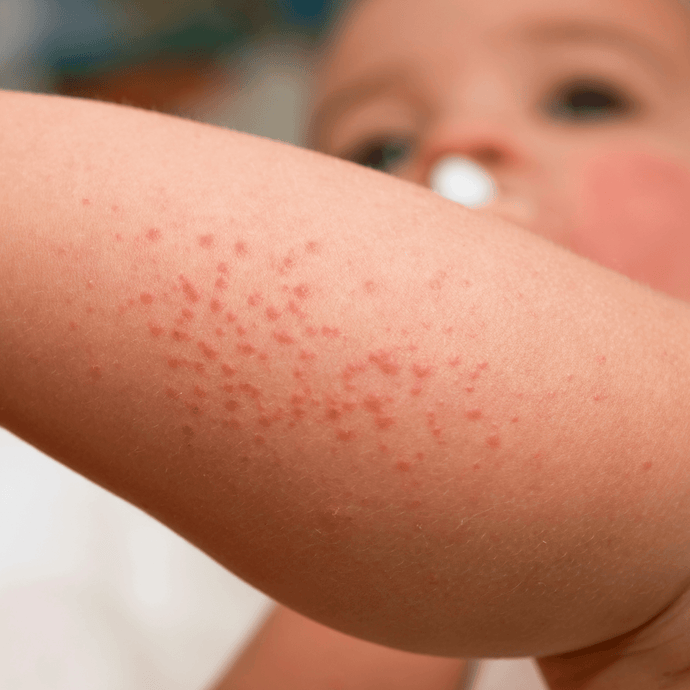 What is diaper dermatitis and how to treat it?